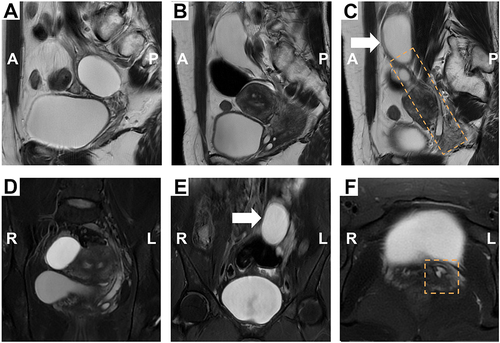 Figure 2 Images of MR. Sagittal turbo spin-echo (TSE) T2-weighted imaging (T2WI) (A-C), coronal T2WI (D-E), and axial T2WI with fat suppression (F). Sagittal and coronal T2WI showed an oval cyst in the right ovary (A and D). Another oval-shaped cystic lesion is observed above the uterus, with a long tubular tortuous downward extension on the left side of the pelvic cavity (B and E). However, careful examination revealed a maldeveloped ureter accompanying the uterus, the end of which was fused with the vagina (C and F). (Arrow: ectopic kidney; dotted line box: ectopic ureter).