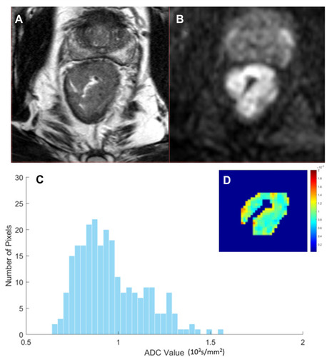 Figure 4 A 63-year-old male patient with confirmed pT3N0 rectal cancer. (A) Maximum axial T2-weighted image showing irregular thickening of the rectal wall with intermediate signal intensity in the lower segment of the rectum. (B) The corresponding maximum axial diffusion-weighted image (DW) image of the same lesion for delineation of regions of interest (ROIs). (C) The corresponding apparent diffusion coefficient (ADC) map histogram copied from ROI of DW image showing ADC mean of 0.96×103 s/mm2 and coefficient of variation of 0.183. (D) ADC pcolor map showing that the brighter the color, the greater the value.