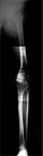 Figure 2 Preoperative full-length, weight-bearing lower extremity anteroposterior view.