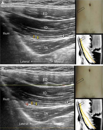 Figure 9 Gray scale (A) and power Doppler imaging (B) for the ilioinguinal, iliohypogastric, and subcostal nerves.
