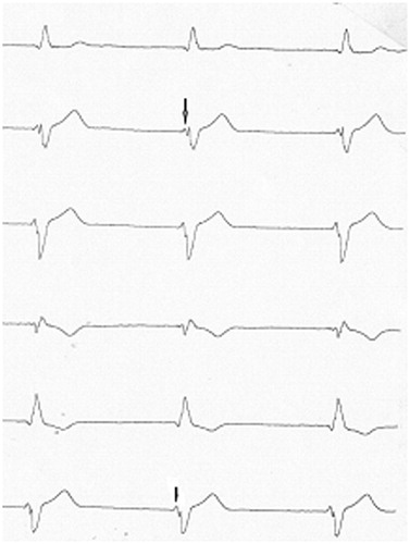 Figure 3. Typical large initial fragmentation of the QRS complex with junctional escape rhythm in an SCN5A gene D1275N mutation carrier. The arrow shows modification in the progressive growing initial fragmentation of QRS complex in inferior leads.