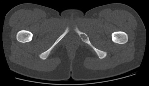Figure 2. CT scan showing enlargement of the left IPS in a 16-year-old female patient with VND.