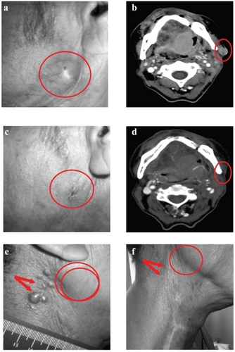Figure 1 Resolution of targeted and nontargeted tumors in response to VB4-845 treatment. Digital photograph (a) and corresponding computed tomography scan (b) of the targeted tumor lesion in patient A at baseline. Circled regions denote location of the targeted tumor. Digital photograph (c) and corresponding computed tomography scan (d) of the VB4-845 treated tumor lesion in patient A at final visit. Circled regions denote location of the targeted tumor as originally seen at baseline. Digital photograph of the location of dermal metastases (arrows) and targeted tumor (circled region) in patient B at baseline (e) and at final visit (f), respectively.