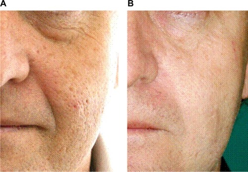 Figure 11 Results of double anterior chemabrasion.