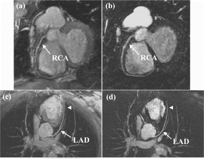 Figure 2. Pre- and post-contrast images of the RCA and LAD. Notice that the fat signal is poorly suppressed in (a) (dashed arrow). The fat and other background signals are well suppressed in (b). As a result, the delineation of the RCA and LAD, especially the distal portions (arrowheads), is markedly improved in post-contrast images (b,d) as compared to pre-contrast images (a,c).