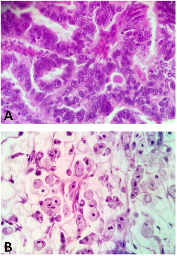 Figure 1. Gastric adenocarcinoma without mucinous component. B. Adenocarcinoma with mucinous component. H + E staining.