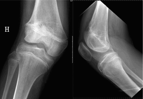 Figure 4. The bony physeal bridge anteriorly and laterally in the distal femoral physis.