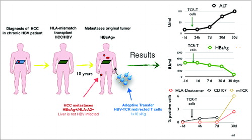 Figure 1. Schematic representation of the clinical history of the treated patient and graphs representing the clinical (ALT), virological (HBsAg) and immunological (frequency of TCR-redirected T cells) parameters after adoptive transfer of TCR-redirected T cells.