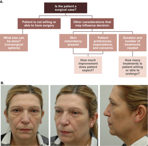 Figure 4 (A) Decision tree illustrating considerations for initial clinical evaluation of patient candidacy for surgical correction of lower face/neck; (B) case example of a Hispanic female, 59 years of age, with neck and lower facial aesthetic concerns, which may be most effectively addressed by a combination of nonsurgical (eg, chin retrusion and poorly defined gonial angle) and surgical treatment (eg, skin laxity, mandibular bone loss, blunted mandibular angle, and prominent melomental folds, jowls, and submental fat). Photos courtesy of V. Bertucci, MD.