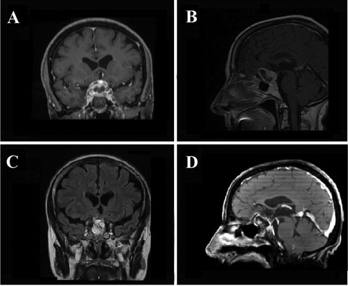 Figure 1. Case 1. Preoperative coronal (A) and sagittal (B) contrast-enhanced T1-weighted MR images showing a large TSM with superior extension. Postoperative coronal (C) and sagittal (D) contrast-enhanced T1-weighted MR images showing GTR of the TSM.