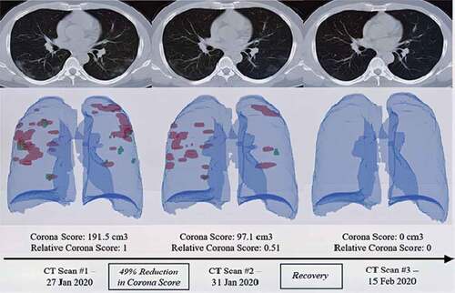 Figure 2. The RADLogics method calculates the amount of recovery using a specific score based on different computed tomography (CT) scans (Scudellari, Citation2020)