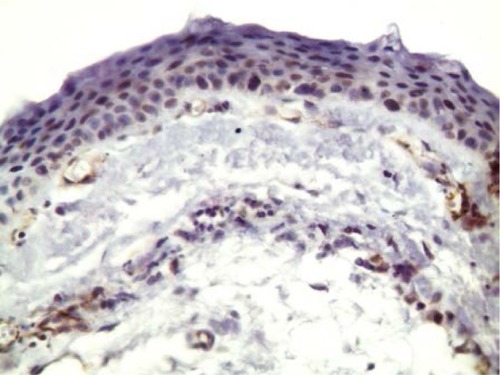 Figure 6 A photomicrograph of noninjected pterygium section immunostained with CD31 antibody showing numerous CD31-positive vessels in subepithelial and connective tissue stroma.