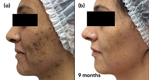 Figure 6 Case study 3 improvement on both sides of face, baseline to 9 months (a) Baseline (b) 9 months with spironolactone 50mg twice a day plus AZA 15% gel twice a day.