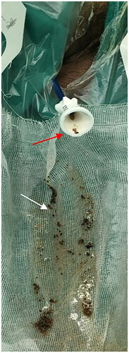 Figure 3. Stone powder and fragments (white arrow) flushed out through the ureteral access sheath (red arrow) during lithotripsy.