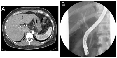 Figure 1 Computed tomography (axial image, arterial phase) and endoscopic retrograde cholangiography findings. (A) Computed tomography imaging shows no mass lesion. (B) endoscopic retrograde cholangiography shows no stones in common bile duct and no extrahepatic biliary duct dilatation.