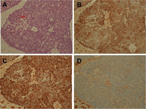 Figure 3 Pathology of developed tumor after inoculation of 10 A549 cells.Notes: (A) Hematoxylin and eosin staining. (B) Immunostaining for anti-human pancytokeratin. (C) Immunostaining for anti-human vimentin. (D) Negative control without primary antibodies.