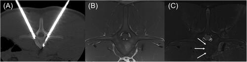 Figure 8. Transverse CT and MRI images of the L1 vertebra with anatomic right on the left side of the images. (A) CT image with dMWA applicator in the left aspect of the vertebral body and fiberoptic sensor in the right. (B) T1-weighted MRI image of L1 showing focal, semi-circular region of hyperintensity axial to the tract previously occupied by the dMWA applicator. (C) T2-weighted MRI image with fat saturation. Note the faint hyperintense rim along the peripheral aspect of the hyperintense region seen in the T1-weighted image (outlined by white arrows).
