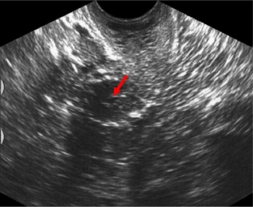 Figure 2 Ultrasonographic guidance of the puncture.