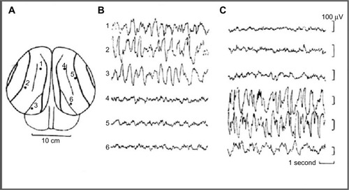 Figure 1 EEG recorded from occipital–parietal derivations.