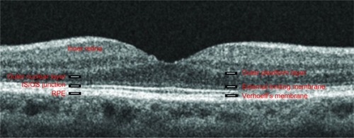 Figure 1 Spectral-domain optical coherence tomographic image of a human fovea.