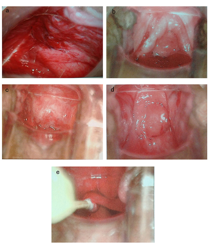 Figure 3 The colposcopy images of the neovaginal mucosa regenerative process of a patient after vaginal reconstruction using SIS graft. (a) A month later. (b) Three months later. (c) Six months later. (d) Nine months later. (e) Colpolypus of another patient.