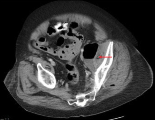 Figure 1 Initial CT-scan showing abscess with air–fluid level abutting left psoas muscle, indicated by red arrow.