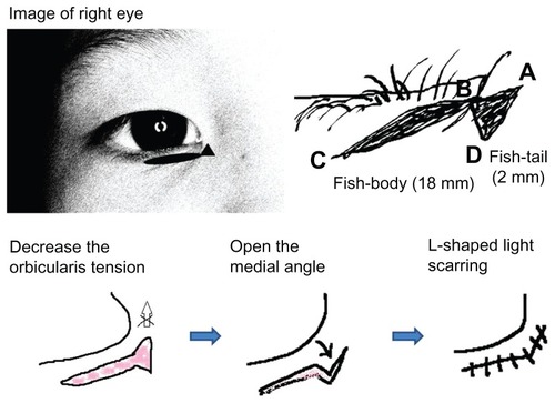 Figure 1 Schematic fish-tail resection.