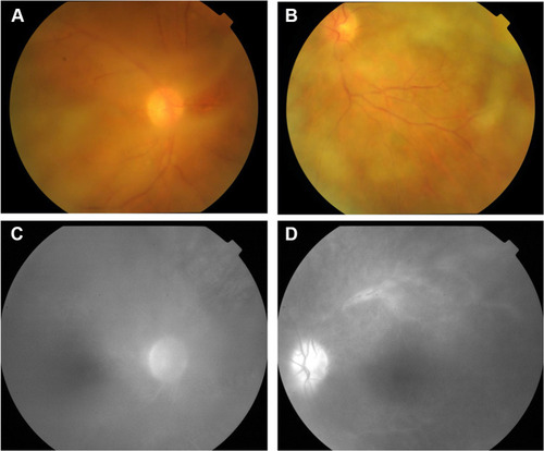 Figure 1 Fundus examination is not clear, and small patches of yellow-white lesions could be seen. (A) OD; (B) OS. Fundus fluorescein angiography shows retinal venous engorgement with fluorescein leakage and high fluorescence of the optic disc. (C) OD; (D) OS.