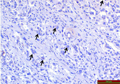 Figure 7 Light microscopic examination of TRPC1 immunoreactivity immunohistochemical staining in High-Grade colon adenocarcinoma tissues. Arrows indicate areas of immunohistochemical staining.