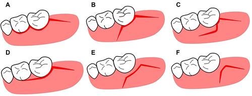 Figure 2 Illustration of the flap designs used in impacted mandibular third molar extraction: (A) standard envelope flap, (B) standard triangular flap, (C) Szmyd flap, (D–F) modification flaps.