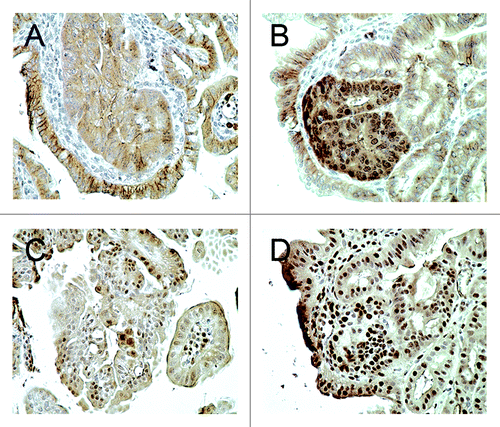 Figure 3. (A) Membranous and cytoplasmic β-catenin immunohistochemical staining was observed in the adenomas of Cables1+/+ ApcMin/+ mice, but there was minimal nuclear staining. (B) In the adenomas of Cables1−/− ApcMin/+ mice, there was nuclear immunopositivity for β-catenin. (C) A low proportion of epithelial cells were PCNA positive in adenomas from Cables1+/+ ApcMin/+ mice. (D) In the adenomas of Cables1−/− ApcMin/+ mice, a high proportion of epithelial cells were PCNA-positive by immunohistochemistry.