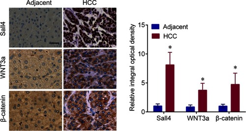 Figure 1 The representative IHC staining of Sall4, WNT3a and β-catenin in the HCC and adjacent normal tissues, and semiquantification. Scale bar, 100 μm. *P<0.05 vs adjacent control.Abbreviations: HCC, hepatocellular carcinoma; IHC, immunohistochemistry; Sall4, Spalt-Like Transcription Factor 4.