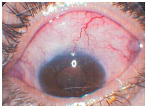 Figure 1 Flat vascularized failing bleb of eye 5 before needling.