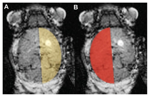 Figure 1 Schematic identification of the (A) tumoral hemisphere and (B) contralateral tumor-free hemisphere.