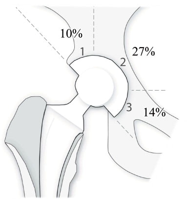 Figure 3. Radiolucencies around the acetabulum in the RingLoc group.