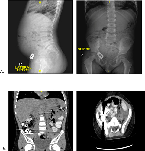 Figure 2 (A) Multiple rounded radiopaque foreign body is noted in the right lower quadrant suggestive of magnet toy, on lateral view it appears anterior in location and away from the rectum. No signs of bowel perforation or obstruction with severe noted constipation. (B) CT of the child showed an Impacted foreign body in the distal small bowel at the ileocecal junction with a proximal mild to moderate small bowel loop dilatation. No signs of free intraperitoneal air.