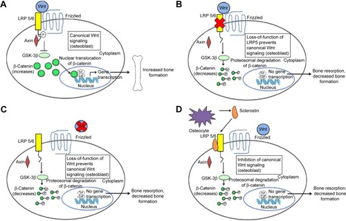 Figure 1 The canonical Wnt-β-catenin signaling pathway and the effects of inhibition through loss of function mutations and sclerostin inhibition.