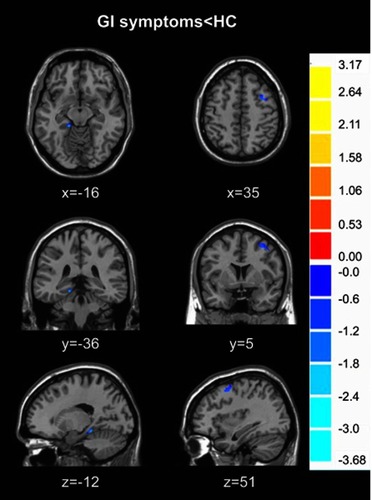 Figure 4 Regional GM volume differences between GI symptoms group and HCs group displayed on axial, coronal and sagittal slices. Numbers indicate x, y and z slices and are displayed in MNI coordinates. Blue color denotes decreased GM volume. The color bars indicate the T-value based on two-sample t-test. (voxel- P <0.01, cluster- P <0.05, cluster size>50, GRF correction).Abbreviations: HC, healthy control; GM, gray matter; MNI, Montreal Neurological Institute; GI:  gastrointestinal symptom; GRF, Gaussian Random Field.