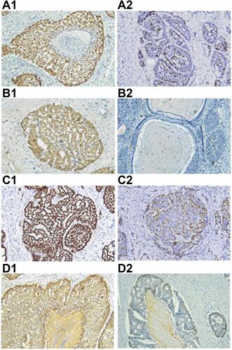 Figure 2 Immunohistochemical analysis of BSCC cases (×200). (A1) Ki-67 is strongly expressed in almost all tumor nuclei. (A2) Low expression of Ki-67. (B1) Strong nuclear expression of p53 in the tumor nests. (B2) Negative expression of p53. (C1) Tumor nuclei was strongly immunoreactive for p63 in immunopositive samples. (C2) Tumor cells were immunonegative for p63 were rarely immunoreactive. (D1) Strong membranous staining for EGFR diffusely found in the tumor nests. (D2) Low EGFR expression.