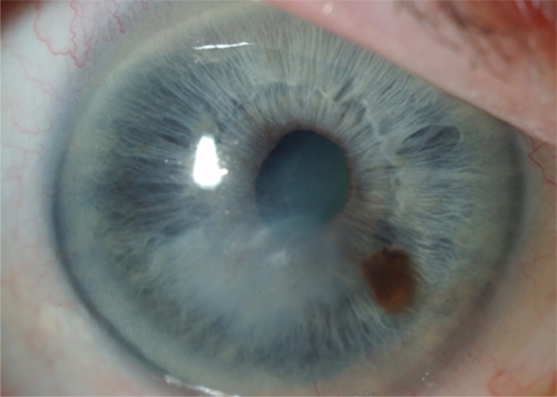 Figure 3 Complete resolution with a central corneal scar one year later.