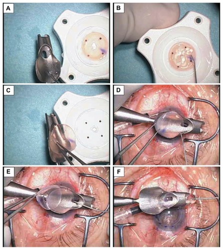 Figure 2 Technique for loading donor endothelial-lamella onto a Busin glide. (A) The Busin glide surface is wetted with several drop of balanced salt solution; (B) Drops of dispersive ophthalmic viscosurgical device are placed onto the endothelial surface; (C) The composite is transferred onto the Busin glide; (D) Hydrodissection of the potential space between donor-endothelial lamella and microkeratome-dissected cap; (E) The microkeratome-dissected stromal cap is removed without difficulty; (F) The donor lamella is pulled into the Busin glide opening.
