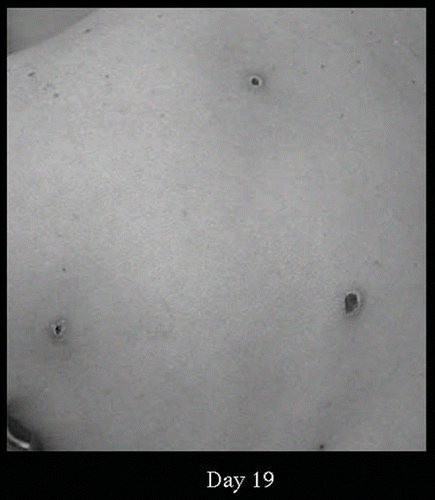 Fig. 4. Skin lesions on day 19 from wasp stings. The necrotic lesion changes into dry necrosis.