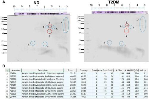 Figure 4 Two-dimensional electrophoresis of ND capsules and T2DM capsule lysates (A) showing a differential spot of approximately 70 KDa with an isoelectric point of 5.5 (spot number 6). (B) LC-MS/MS analysis using the MASCOT algorithm and the NCBInr database showing a 62% homology with human cytokeratin types 1 and 2.