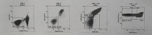 Figure 3 The patient has been diagnosed with PNH (paroxysmal nocturnal hemoglobinuria) through flow cytometry.