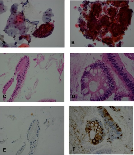 Figure 2 Intestinal metaplasia with no high-grade dysplasia (IMNHGD) and columnar cell with no goblet cells (CCNGC) of EsophaCap samples. (A) CCNGC: The specimen consists of multiple squamous cells and one sheet of glandular cells. The glandular cells are well organized. No goblet cells are identified. (B) IMNHGD: The specimen consists of multiple sheets of glandular cells. The glandular cells are well organized. Focal goblet cells are present (arrowhead). (C and E) CCNGC: One columnar cell gland is present in cell block. The columnar cells are negative for MUC2 immunostain; (D and F) IMNHGD: Goblet cells are present in cell block. The goblet cells and adjacent columnar cells are positive for MUC2 immunostain.