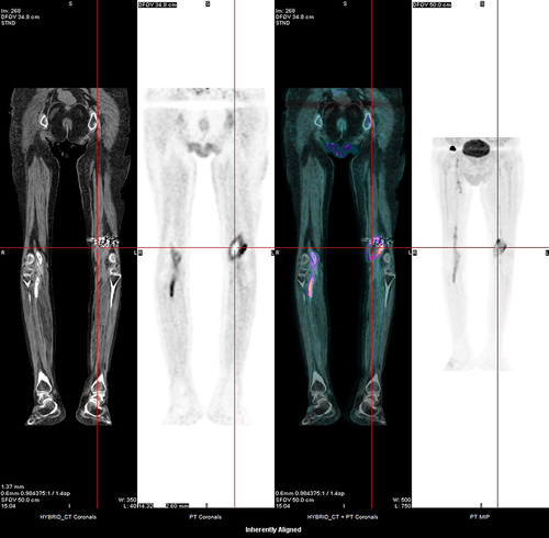 Figure 2 FDG-PET-CT image showing abnormal 18F-flurodeoxyglucose uptake in and around the popliteal artery stent region, suggestive of an active infective. There is possible abscess formation around the left stent.