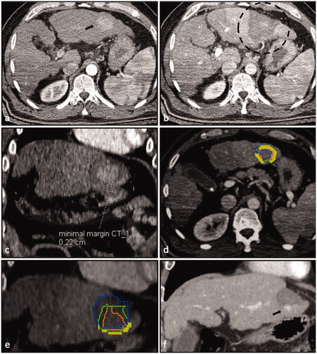 Figure 2. Case 1 of the so-called ‘ablation assessment quiz’: 63-year old male with a 34 mm HCC. Axial plane of pre-interventional CT-scan (a) with HCC in liver segment III (black arrow) and post-interventional CT-scan (b) with large necrosis zone (black dashed circle). (c) Axial plane after image fusion of pre- and post-interventional CT-scans with a rigid registration tool (Syngo.via, Siemens Healthineers, Erlangen, Germany) revealing a MAM of 2 mm. Axial (d) and coronal (e) plane after image fusion of pre- and post-interventional CT-scans with a non-rigid registration tool (Ablation-fit, R.A.W. Srl, Milano, Italy) revealing a lack of sufficient MAM in caudal position (orange line = HCC; green line = HCC with 5 mm margin; blue = necrosis zone; yellow area = unablated safety margin). (f) LTP with 10 mm in diameter caudally to necrosis zone 19 months after the intervention (black arrow).