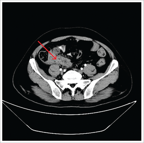 Figure 2. CT scan of abdomen demonstrating a swollen appendix with an unclear border, uneven density, and heterogeneous enhancement is visible (arrow).