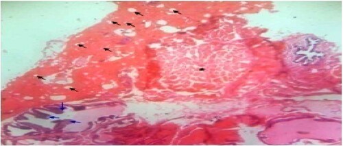 Figure 2. Untreated control: Photomicrograph of prostrate tissue showing slight disruption of architectural appearances (blue arrow) and multiple blood congestions (black star) within the fibromuscular stroma. Enlarged acini (black arrow) also observed. H&E. mag. 400×.