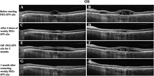 Figure 10. Serial macular OCT of the left eye obtained during the treatment course of Patient 2. The same cuts of representative OCT images in the left eye from various time points were used for comparison. A-B. Persistent multifocal SRF and IRF despite multiple sessions of PDTs and various empiric treatments of CSCR, and immunomodulatory therapies, before starting PEG-IFN α2a monotherapy. C-D. Significant rapid improvement on SRF/IRF after 4 doses of weekly PEG-IFN α2a monotherapy. E-F. Rapid recurrence of SRF/IRF after the patient was off PEG-IFN α2a monotherapy. G-H. Mild residual subfoveal SRF and near resolution of IRF/SRF after restarting PEG-IFN α2a monotherapy.